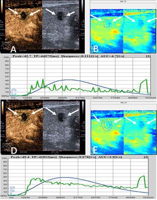 Diagnostic value of qualitative and quantitative parameters of contrast-enhanced ultrasound for differentiating differentiated thyroid carcinomas from benign nodules